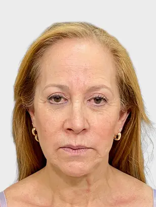 Resultado 1 - Before