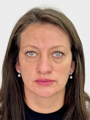 Resultado 2 - Before