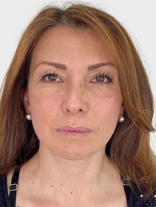 Resultado 1 - BEFORE