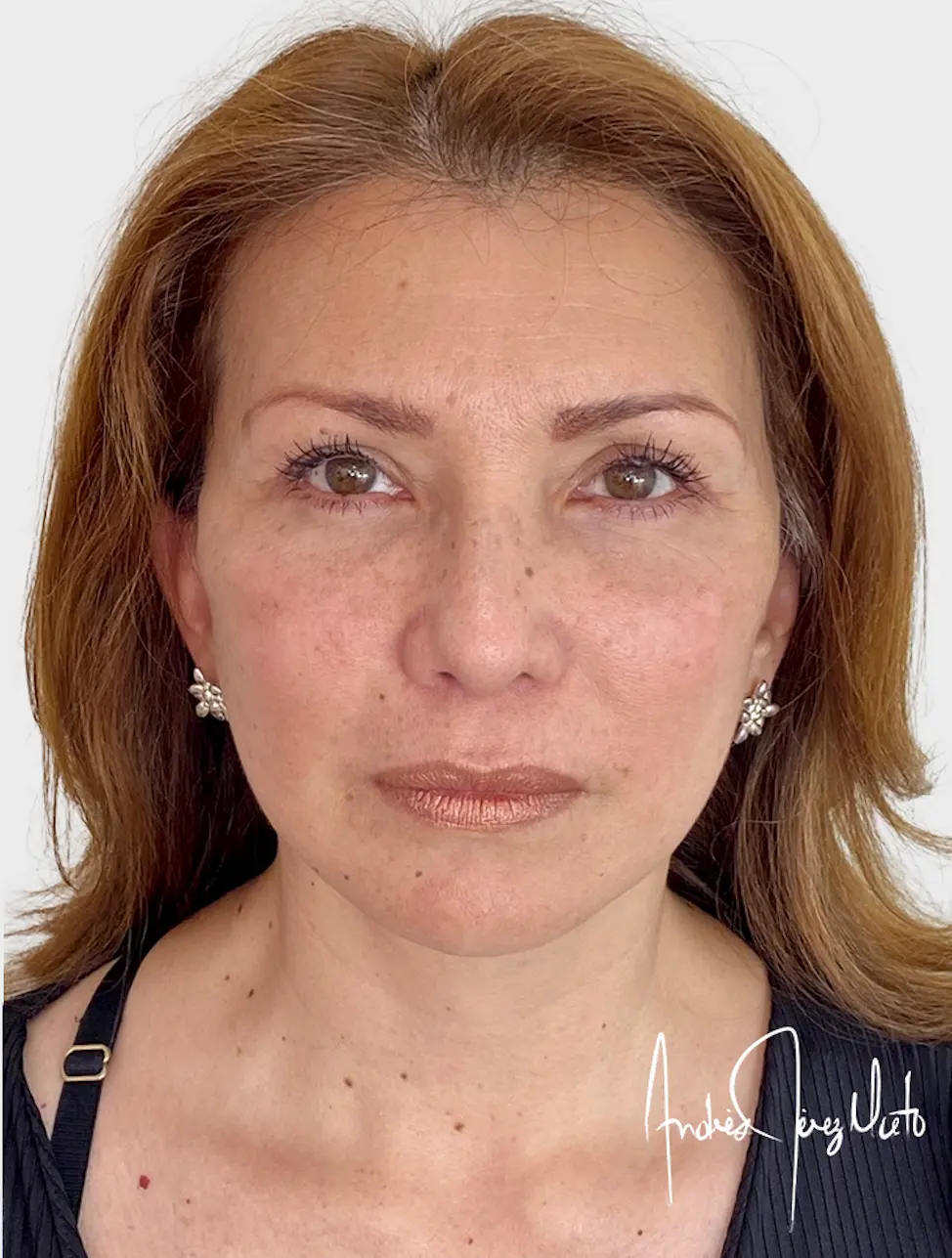 Paciente 1  - Después