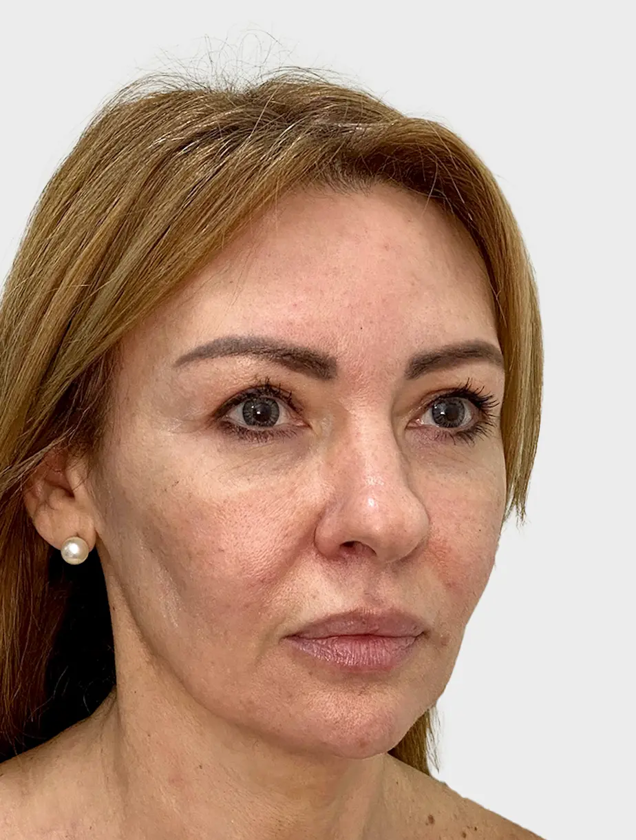 Resultado 1 - Before