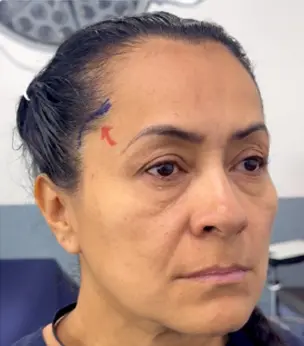 Elevación Temporal Corta