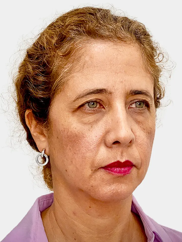 Resultado 1 - Before