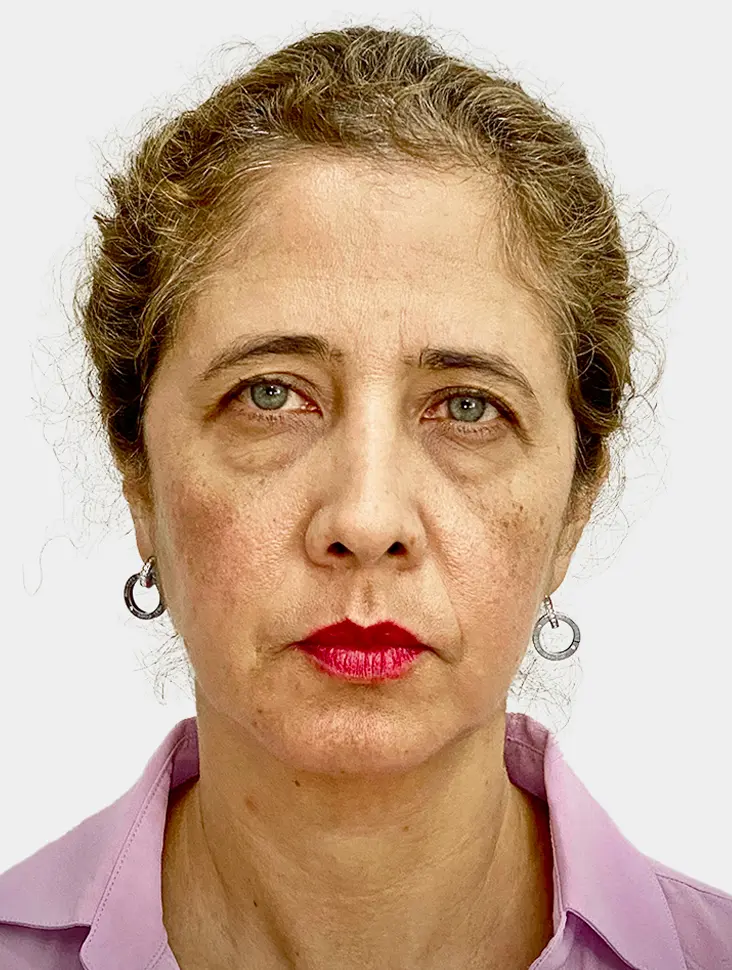 Resultado 2 - Before