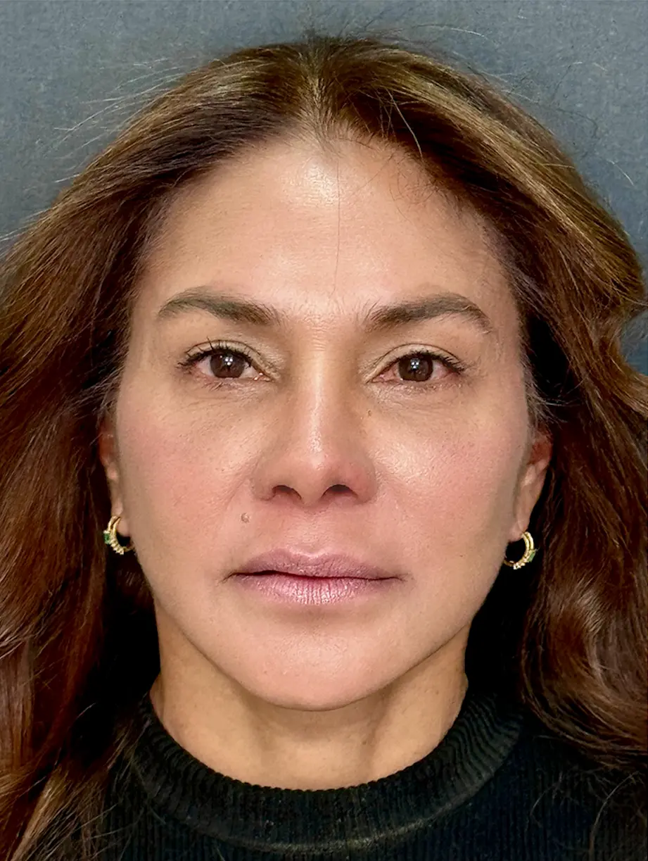 Paciente 1 - Después