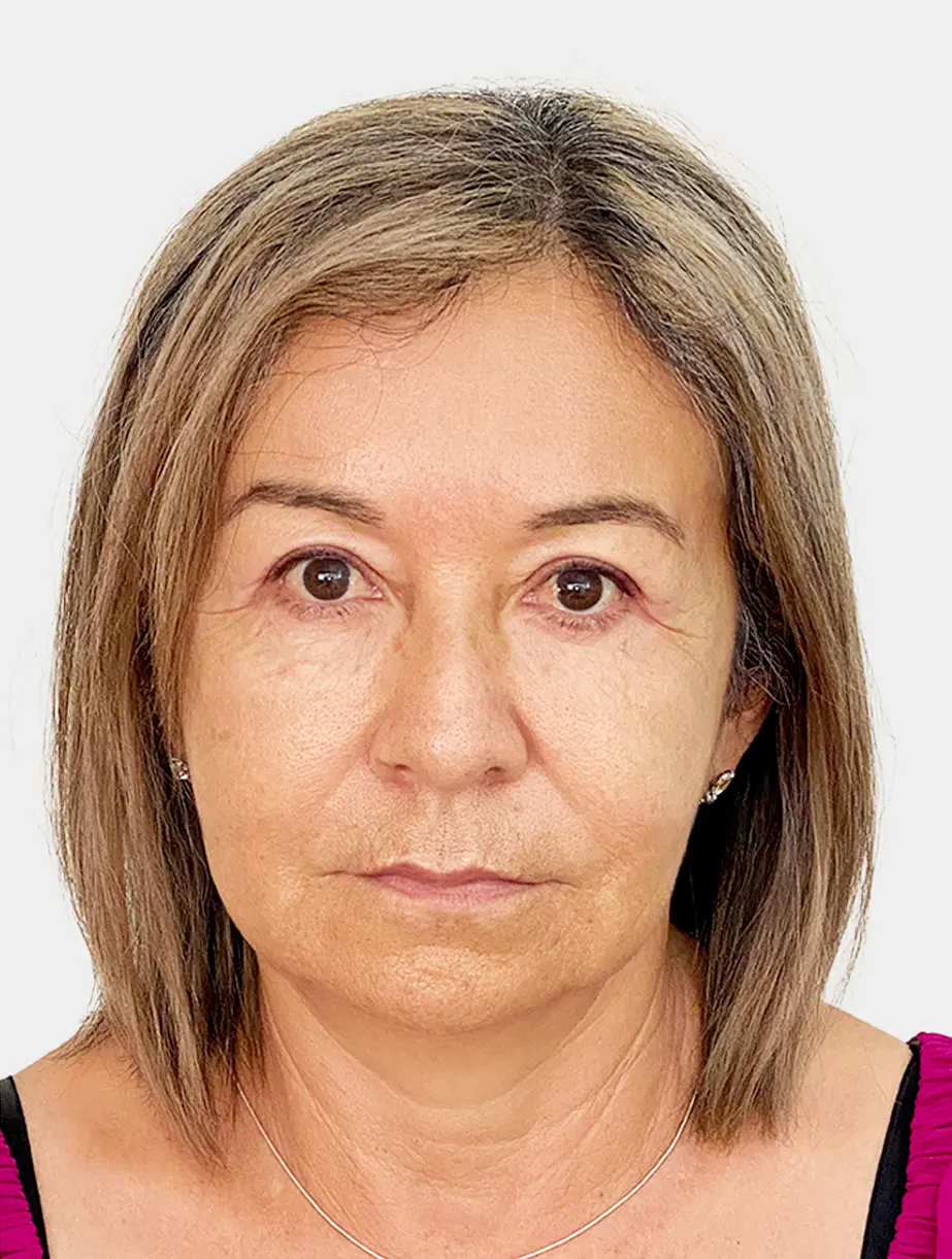 Resultado 1 - Before