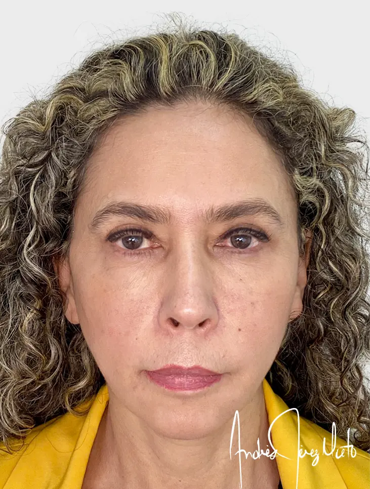 Paciente 1 - Después