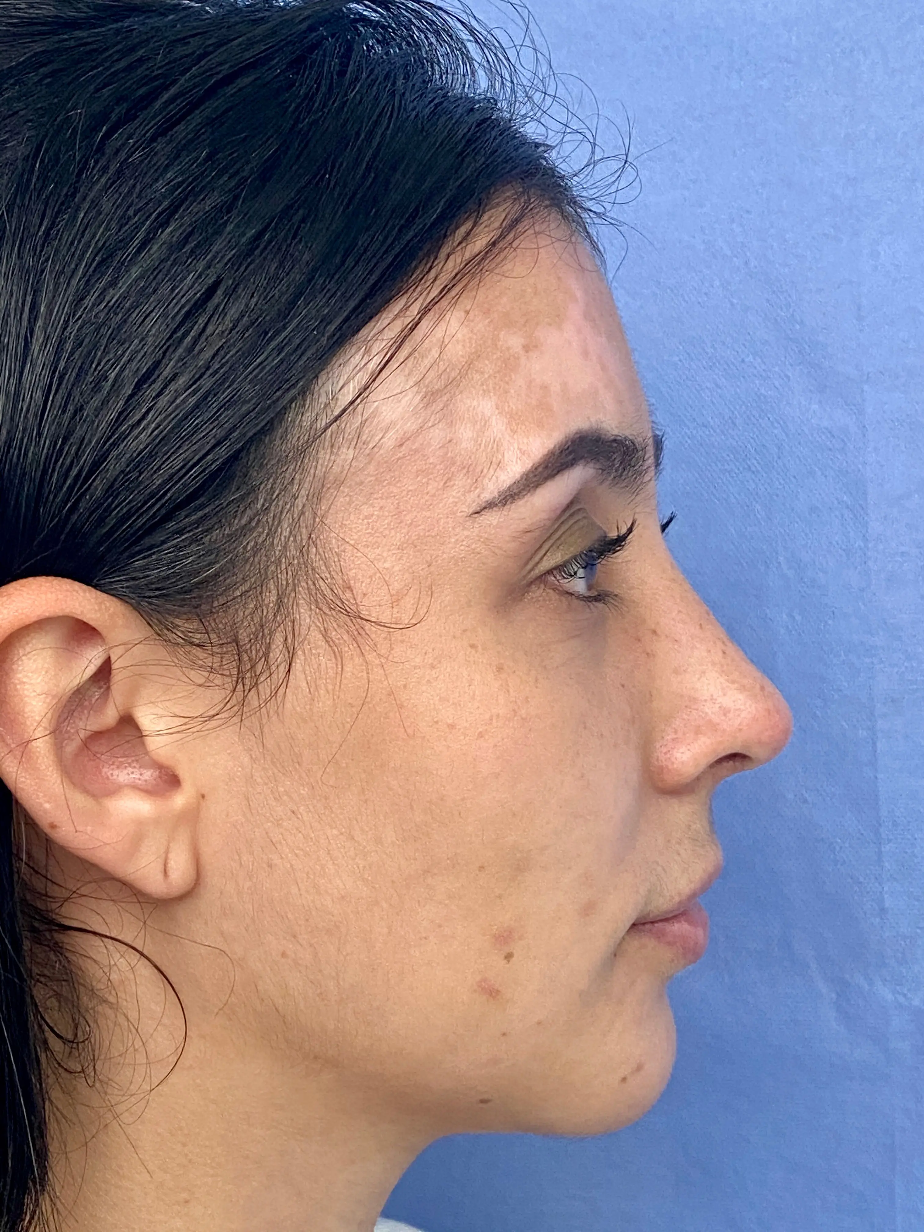 Resultado Mentoplastia 4