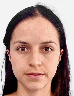 Resultado Rinoplastia 3