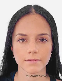 Resultado Rinoplastia 4