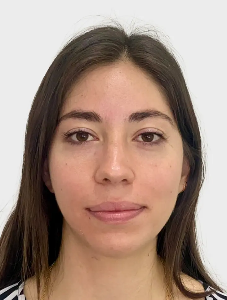 Resultado Rinoplastia 1