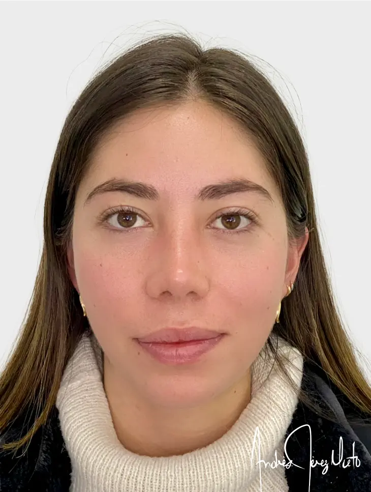 Resultado Rinoplastia 2
