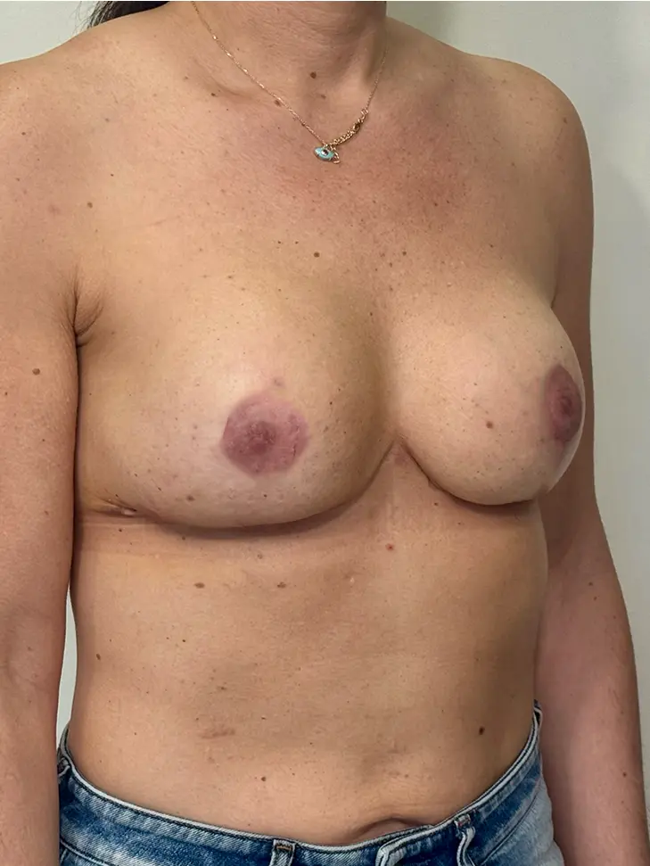 Resultado 1 - Después