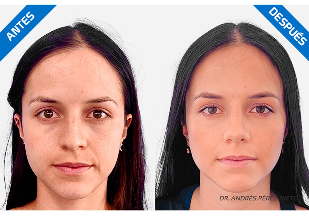 Rinoplastia-testimonio-10