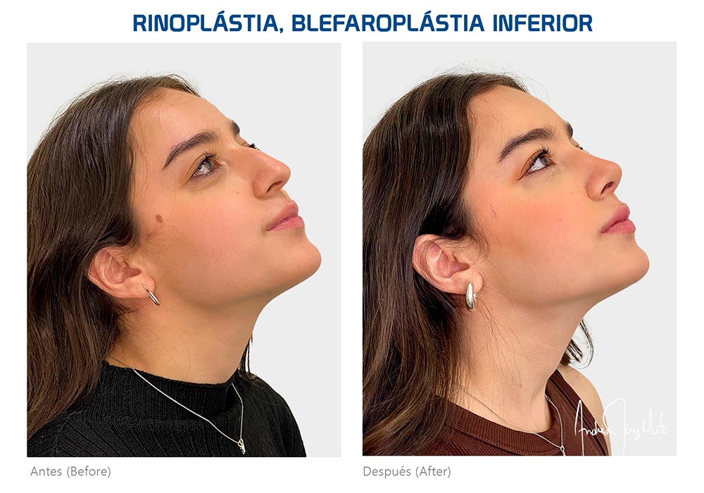 Rinoplastia-testimonio-8