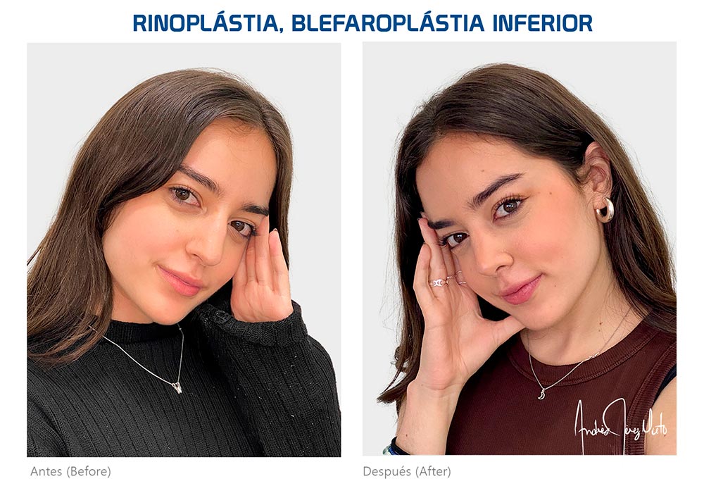 Rinoplastia-testimonio-9