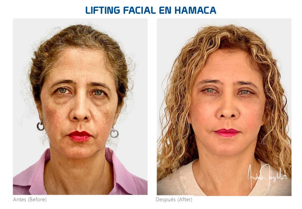 Lifting Facial en Hamaca 